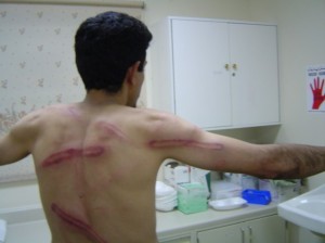 Beating_marks_on_the_back_and_arm_of_Abdulhadi_Alkhawaja_after_police_attacked_a_peaceful_protest_on_15_July_2005-630x472